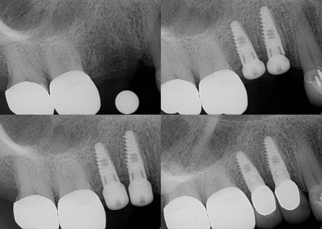 Before Dental Implants - Midlothian, VA