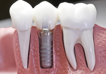 Dental Implants - Midlothian, VA