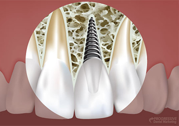 Implant Dentistry - Midlothian, VA