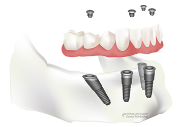 Implant Dentist - Midlothian, VA