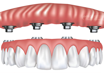 Ball Retained Implant Dentures - Midlothian, VA