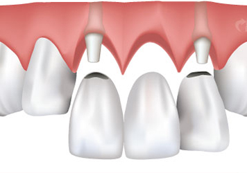 Family Dentist - Dental Crowns - Midlothian, VA