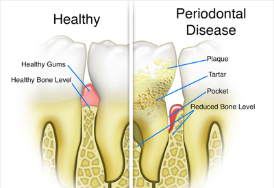 Healthy Gums vs. Gum Disease