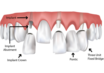 Dental Implants Winterpock, VA